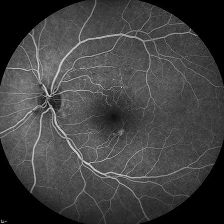 Angiografía retinal con fluoresceína