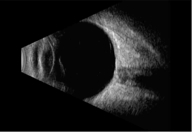 Ecografía ocular modo B