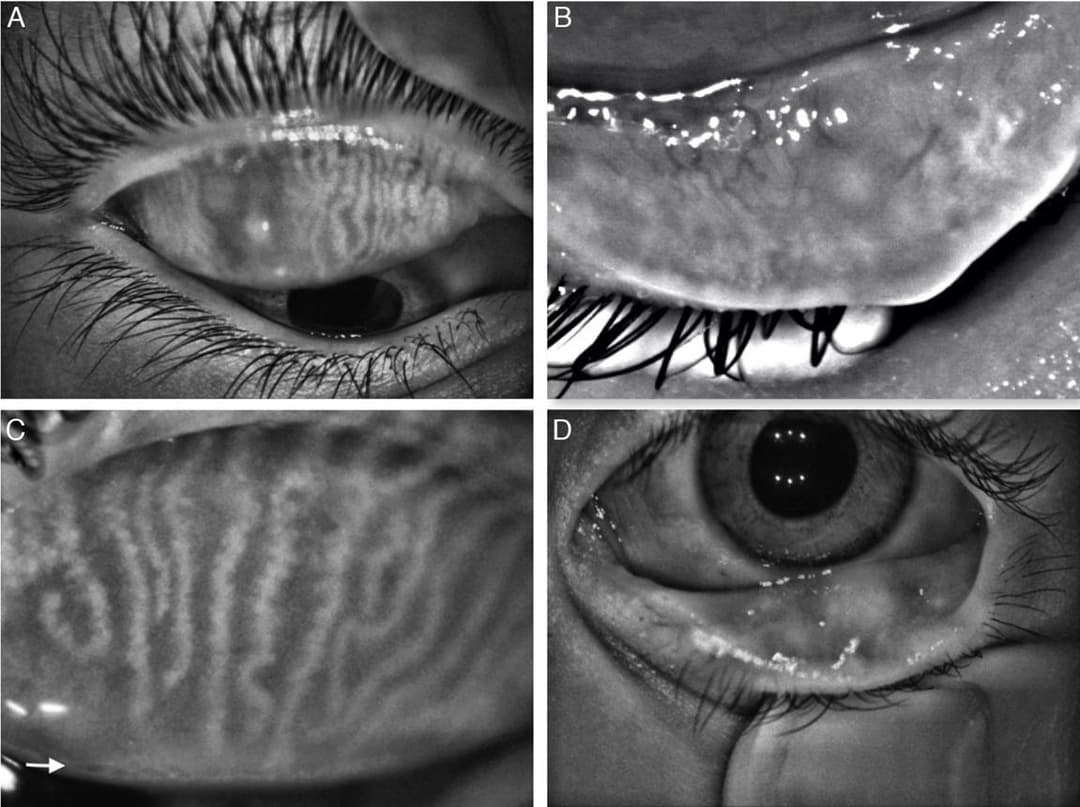 Evaluación de glándulas de Meibomio para ojo seco