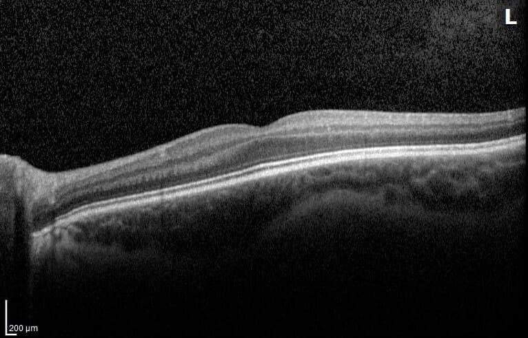 Tomografía de coherencia óptica de mácula