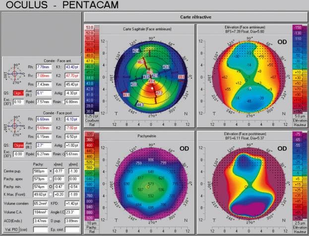 Mapas de topografía corneal Pentacam