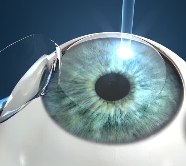 Procedimiento de cirugía refractiva corneal con láser