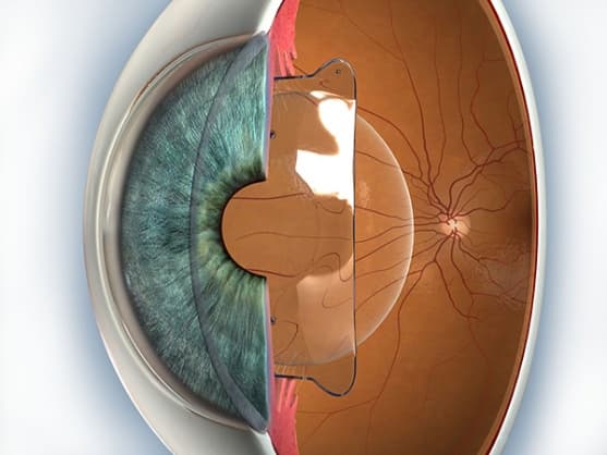 Esquema de lente intraocular fáquica