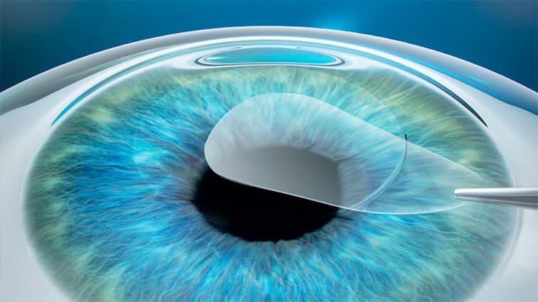 Esquema de técnica SMILE en cirugía refractiva