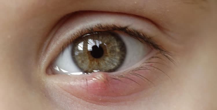 Orzuelo en el margen del párpado inferior