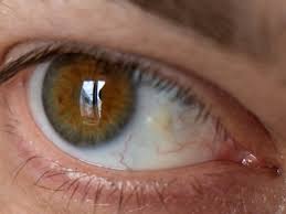 Pingüécula como lesión benigna de la superficie ocular