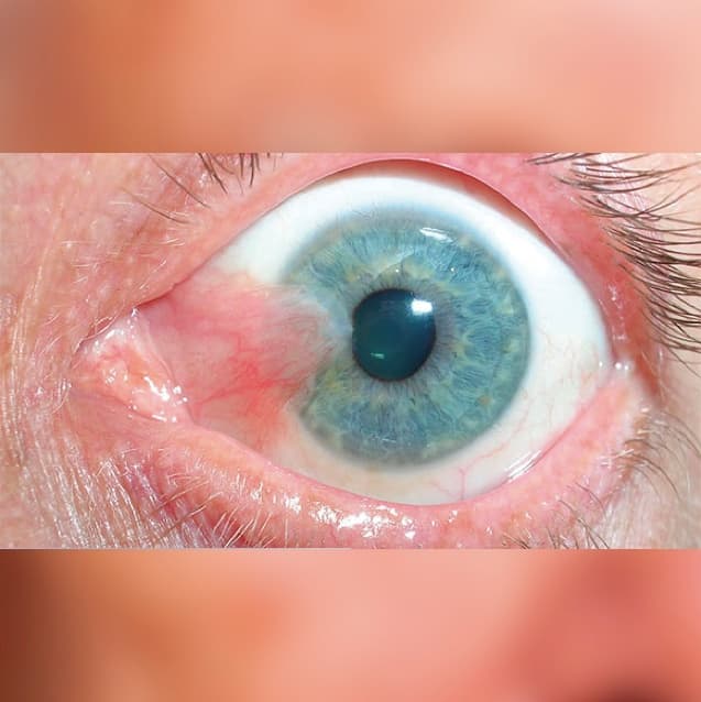 Pterigión nasal sobre la superficie ocular